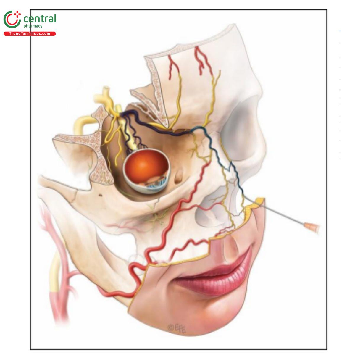 Hình 6. Tiêm động mạch (nhánh hoặc thân của động mạch góc) sẽ chảy theo huyết áp của động mạch này nhưng phải vượt qua huyết áp động mạch mắt để tiếp cận được mạch máu võng mạc và não. Điều này rất có thể đòi hỏi phải liên tục tiêm ở áp suất đủ và một lượng thể tích lớn.