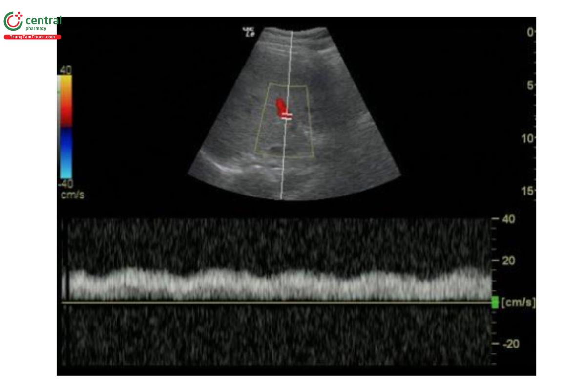Siêu âm Doppler tĩnh mạch cửa bình thường - sóng đơn pha (Normal Monophasic Flow)