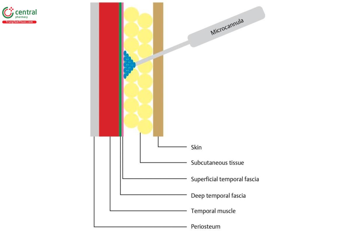 Hình 6.1 Dùng cannula xuyên qua da và mô dưới da cho đến khi chạm tới cân thái dương nông, nơi tiêm axit hyaluronic (HA).