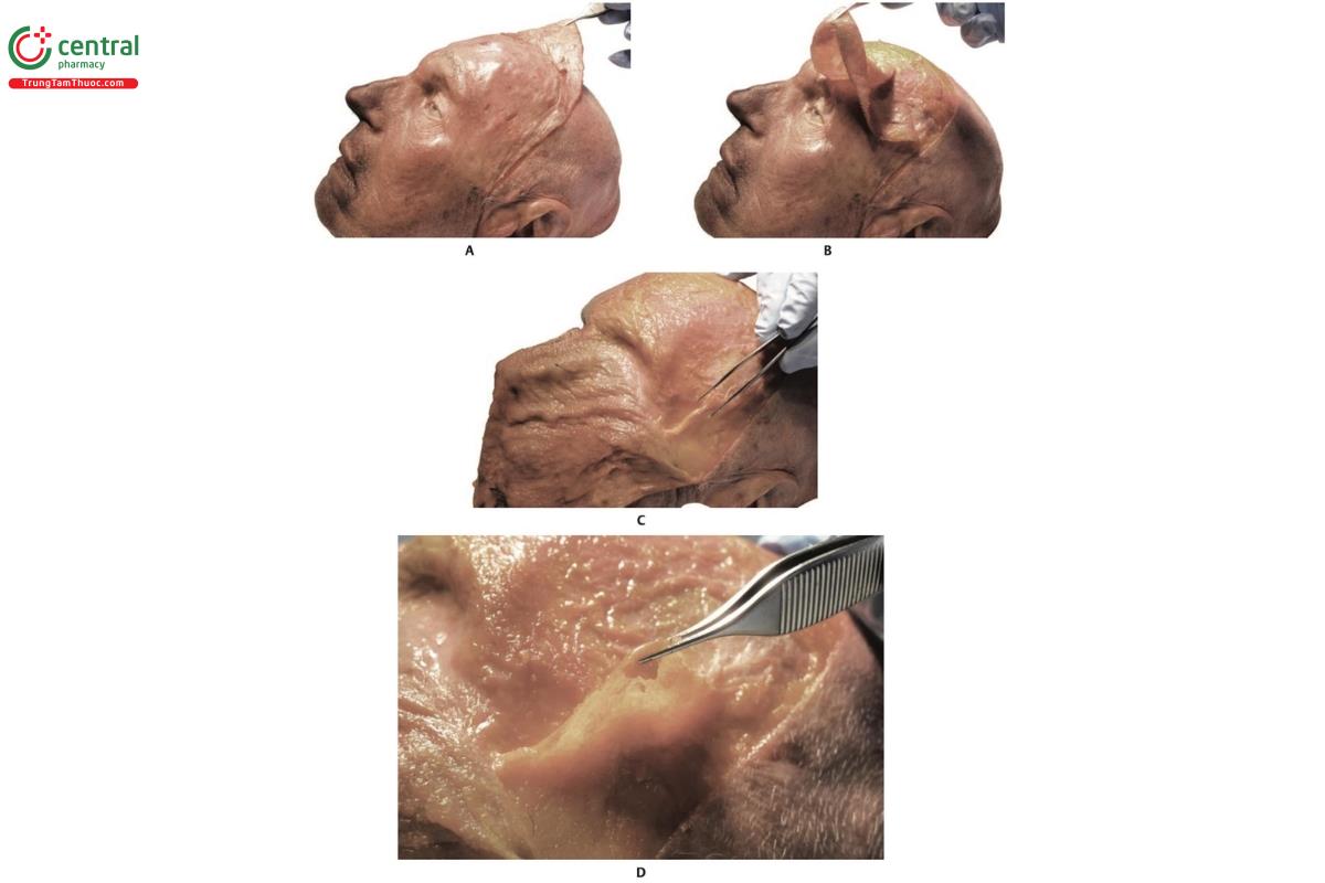 Hình 6.10 A và B. Hình bên trái của xác tươi với da được gấp ngược. C và D. Mô dưới da vùng thái dương.