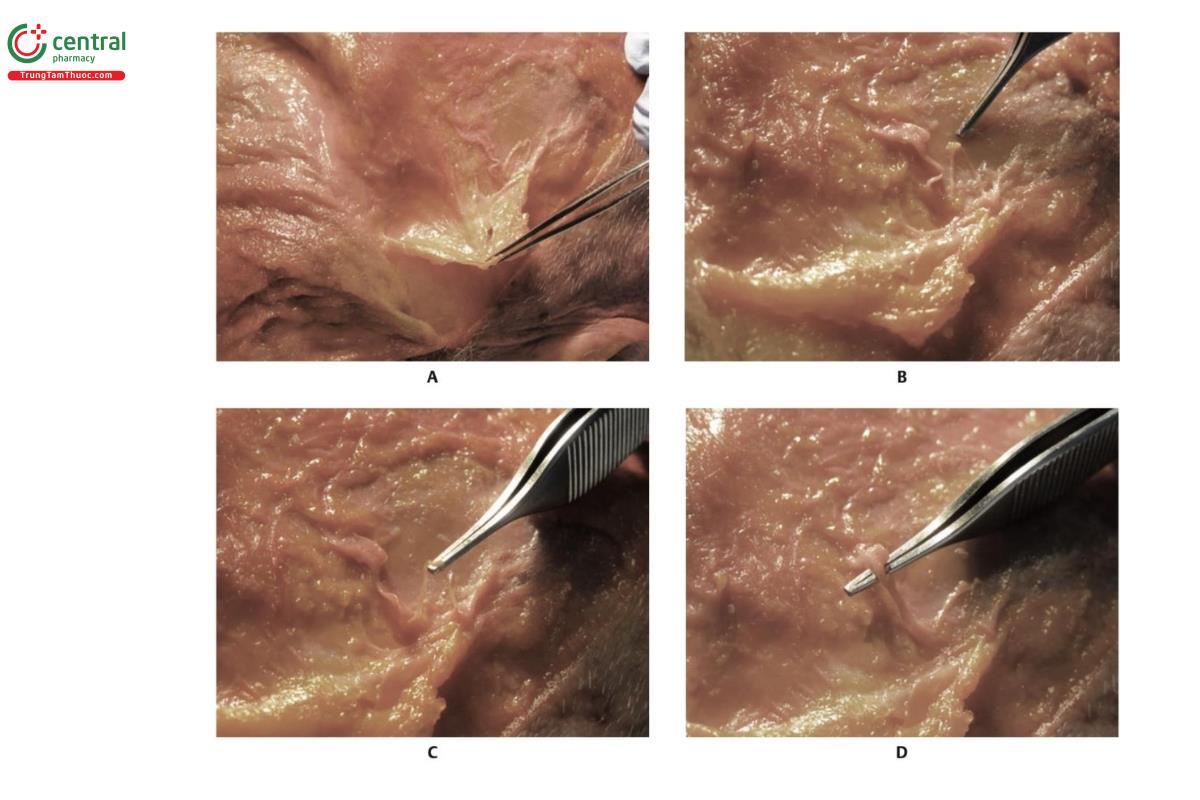 Hình 6.11 A. Mô dưới da của vùng thái dương được gấp ngược một xác tươi. B. Bộc lộ nhánh trước của động mạch thái dương nông (STA) và nhánh thái dương của dây thần kinh mặt. C. Cận cảnh nhánh thái dương của dây thần kinh mặt. D. Cận cảnh nhánh trước của STA.