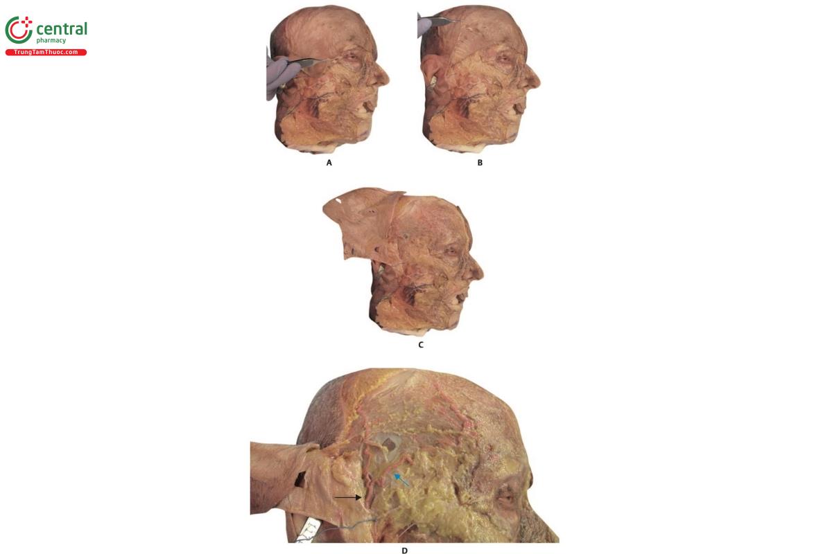 Hình 6.12 A, B và C. Hình bên phải của xác tươi với da được gấp ngược. D. Động mạch thái dương nông (STA) (mũi tên đen) và nhánh trước của nó (mũi tên xanh).