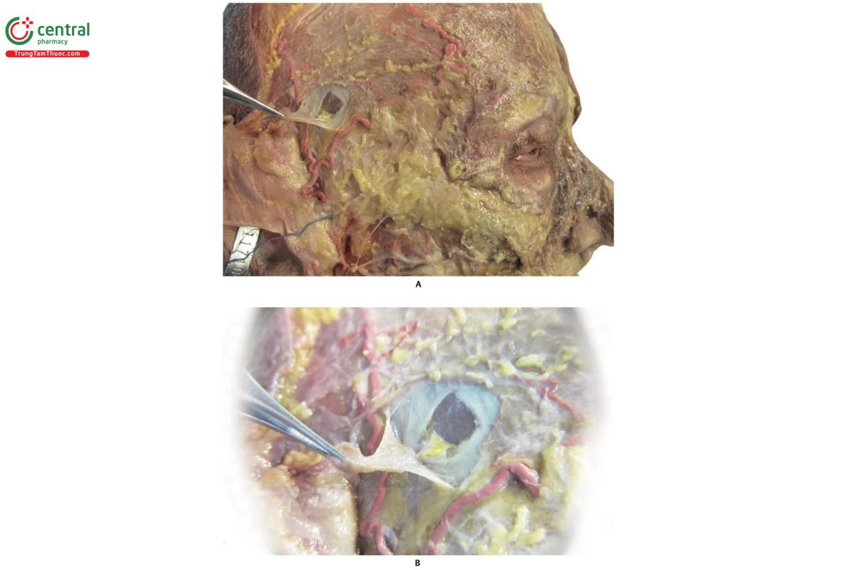 Hình 6.13 A. Cân thái dương nông được kéo lên, cân thái dương sâu bên dưới và ở phía dưới cùng là cơ thái dương. B. Cận cảnh A