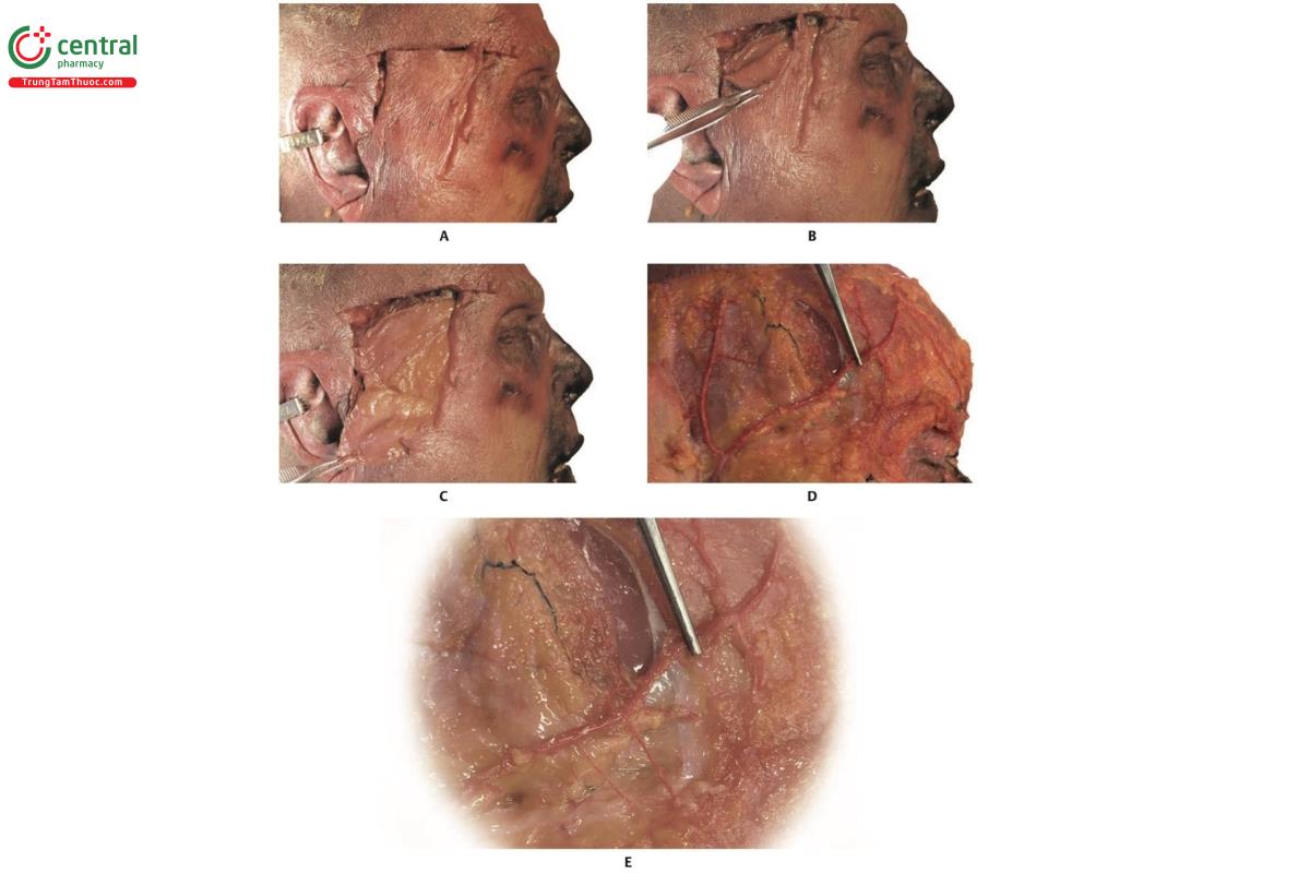 Hình 6.14 A, B và C. Hình bên phải của xác tươi với da được gấp ngược. D và E. Nhánh trước của động mạch thái dương nông (STA) được kéo lên.
