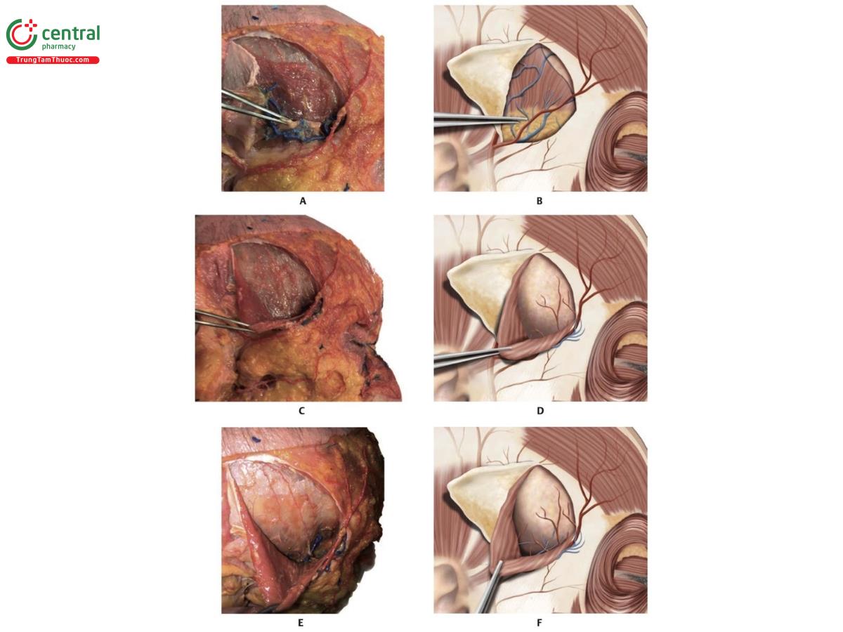 Hình 6.16 A. Hình bên phải của xác tươi cho thấy động mạch thái dương nông (STA); các cân thái dương nông và sâu gấp ngược để lộ các nhánh tĩnh mạch thái dương. Phần mở rộng của khối mỡ má (khối mỡ Bichat) được kéo lên để lộ cơ thái dương bên dưới. B. Hình minh họa tương ứng với hình A. C. Hình bên phải của xác tươi cho thấy cơ thái dương được gấp lại. D. Hình minh họa tương ứng với hình C. E. Sau khi gấp cơ thái dương lại, có thể nhìn thấy màng xương và xương thái dương. Sự mở rộng của các nhánh tĩnh mạch thái dương có thể nhìn thấy ở mặt phẳng sâu và các tiểu động mạch trên màng xương. F. Hình minh họa tương ứng với hình E.