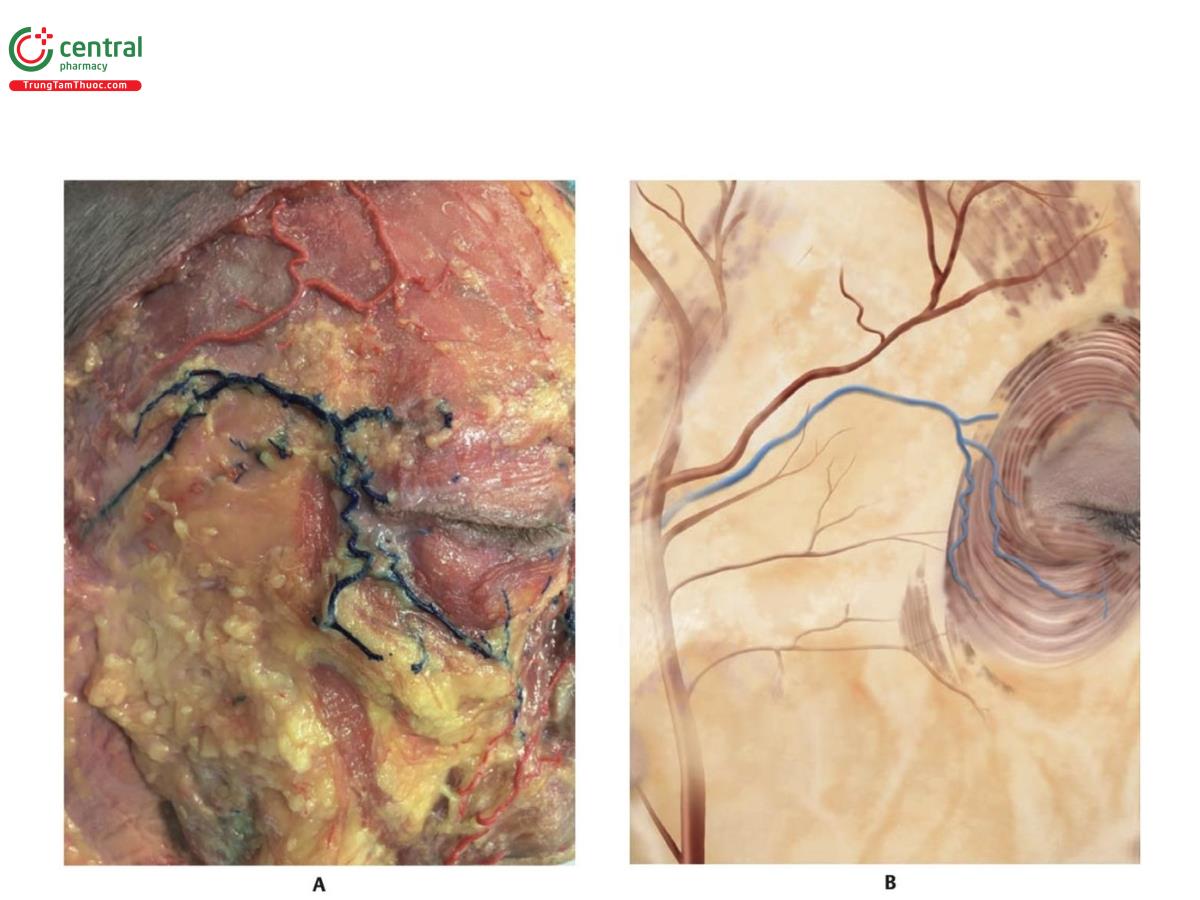 Hình 6.17 A. Vùng thái dương bên phải của xác tươi cho thấy động mạch thái dương nông (STA). Nhánh trán của tĩnh mạch thái dương nông (STEV) thông nối với tĩnh mạch gác cũng có thể nhìn thấy được. B. Minh họa tương ứng với hình A.