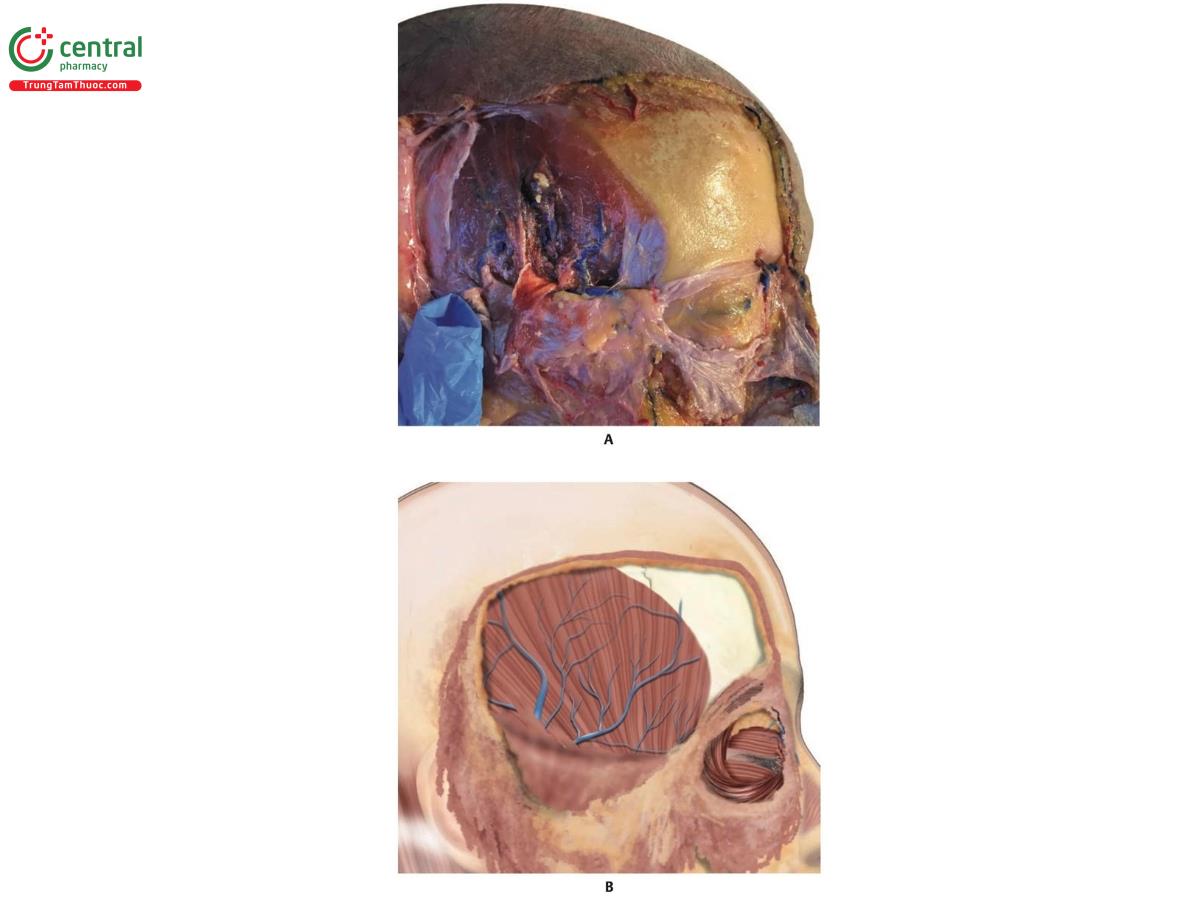 Hình 6.18 A. Các nhánh tĩnh mạch thái dương nằm phía trên cơ thái dương. B. Minh họa tương ứng với hình A.