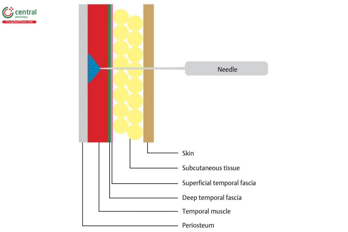 Hình 6.2 Kim xuyên qua da, mô dưới da, cân thái dương nông, cân thái dương sâu và cơ thái dương, tới màng xương và tiêm HA. Nên sử dụng kim 27 G 13 mm (hoặc dài hơn) để tiêm chất làm đầy vào mặt phẳng trên màng xương.