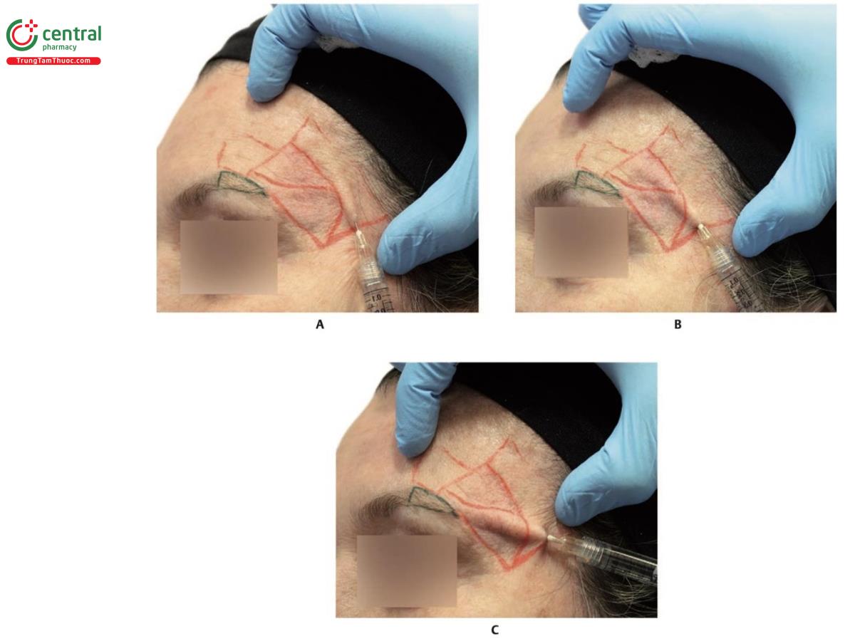 Hình 6.24 A. Hình nghiêng của một người mẫu có vùng thái dương được đánh dấu và cho thấy việc tiêm chính xác một cannula 25 G 40 mm giữa các góc phần tư trong và ngoài. Các vùng thái dương ngoài trên và dưới được lấp đầy thông qua điểm vào này. B. Đưa chính xác cannula 25 G 40 mm vào giữa góc phần tư dưới ngoài và trong. Vùng thái dương trên và dưới được làm đầy thông qua điểm vào này. C. Đưa chính xác cannula 25 G 40 mm vào giữa góc phần tư dưới ngoài và trong. Các vùng thái dương trên và dưới được làm đầy thông qua điểm vào này. Cũng có thể làm đầy phần đuôi cung mày bằng cannula ở vị trí này.