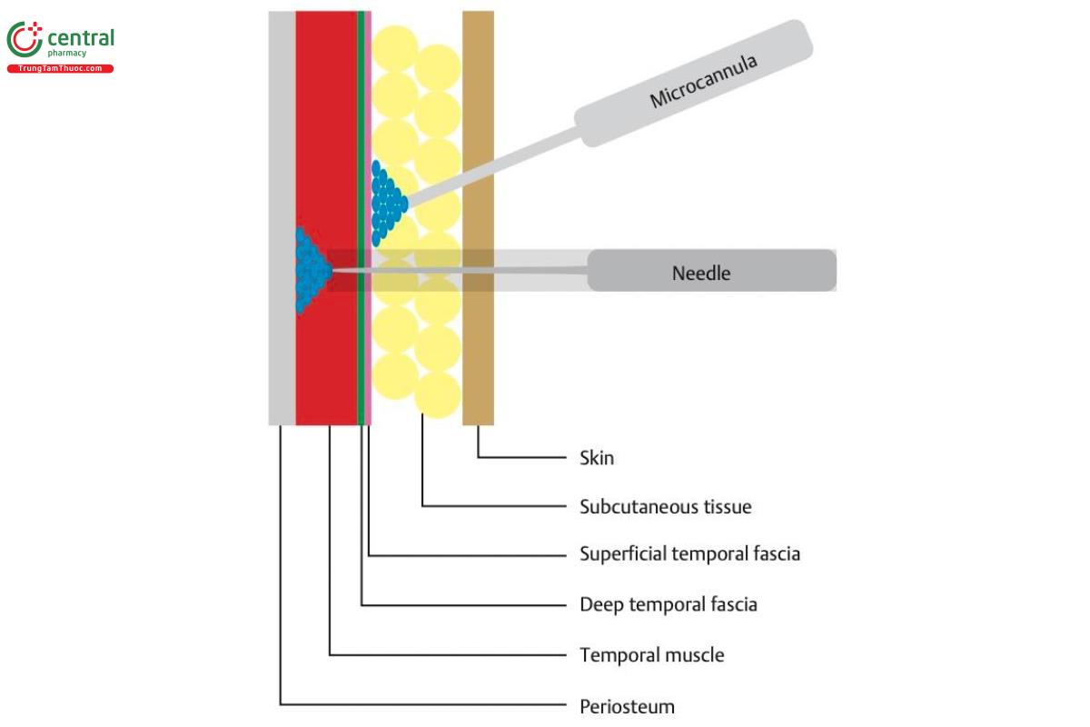 Hình 6.3 Mô phỏng quá trình tiêm nông chất làm đầy vào mô dưới da bằng cannula, phía trên cân thái dương nông và tiêm sâu bên dưới cơ thái dương trong mặt phẳng trên màng xương.
