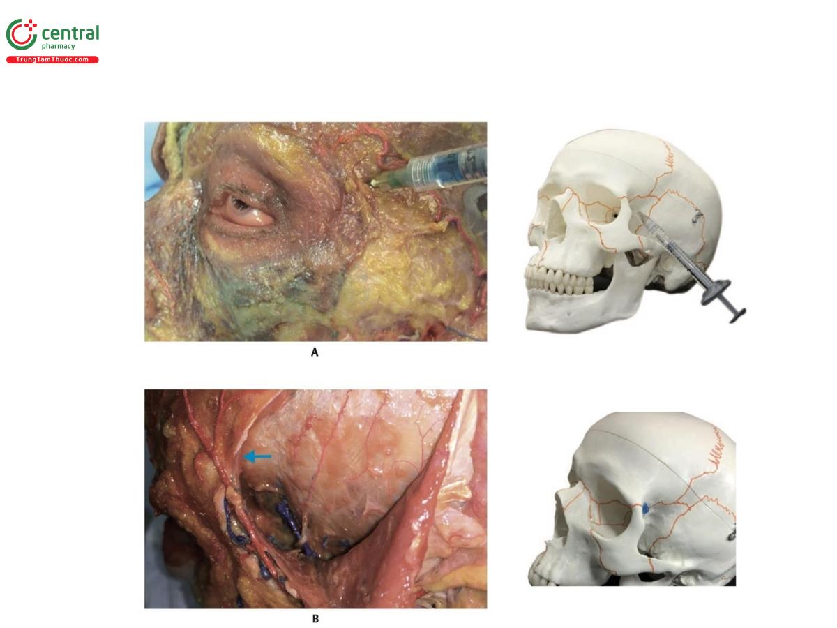 Hình 6.32 A. Mô tả kỹ thuật tiêm sâu bằng kim vào mặt phẳng trên màng xương, ở góc phần tư trên trong của vùng thái dương bên trái của xác tươi và hộp sọ. Lưu ý rằng kim được chèn vuông góc tại vị trí tiêm. B. Vùng thái dương bên trái của xác tươi, với cơ thái dương gập ngược, cho thấy mặt phẳng trên màng xương của xương thái dương. Mũi tên màu xanh chỉ vào góc phần tư trên trong của vùng thái dương, nơi có ít nguy cơ thủng mạch máu hơn. Chấm màu xanh cho thấy điểm trong hộp sọ nơi sản phẩm được tiêm.