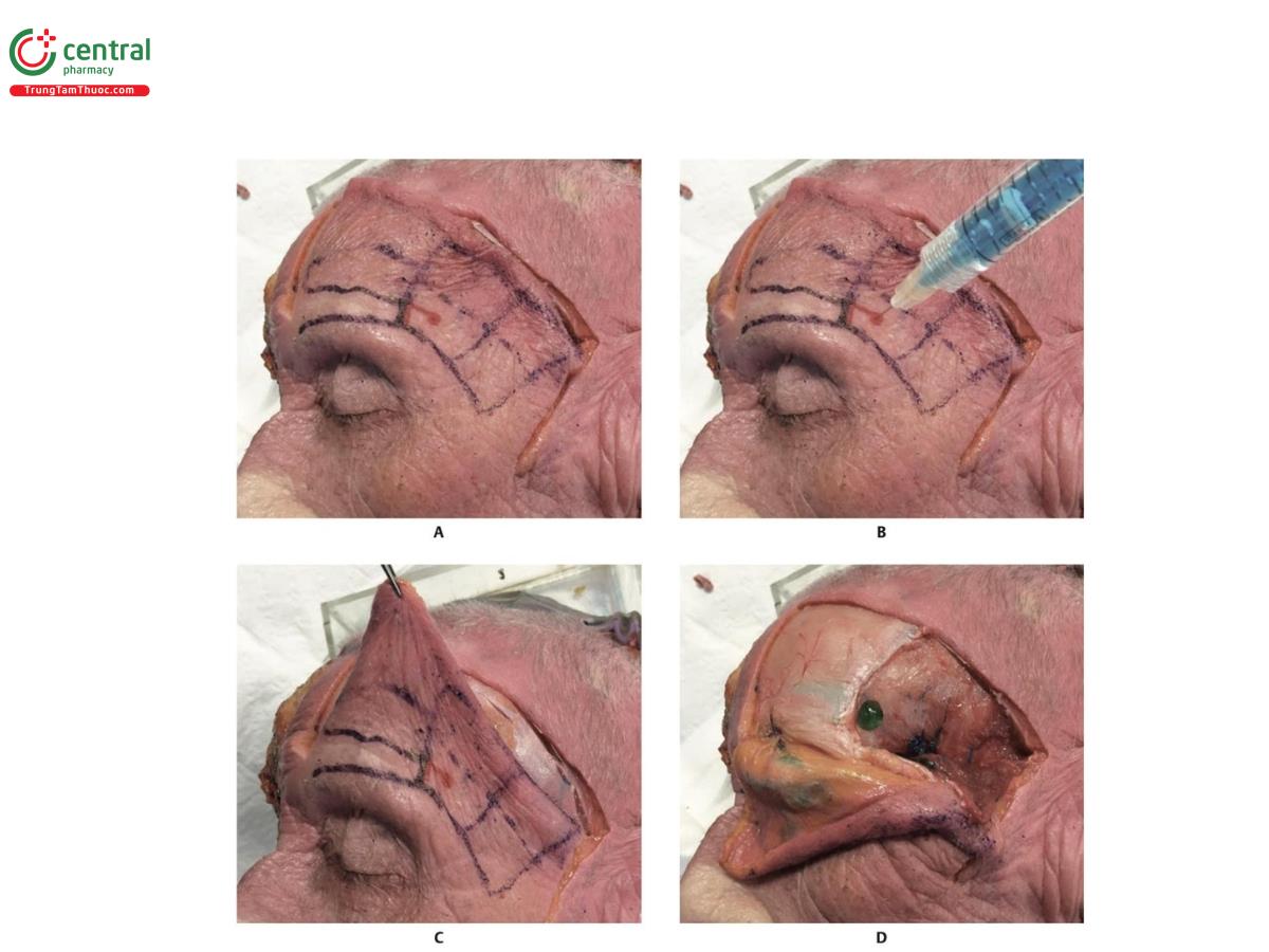 Hình 6.33 A. Dấu chấm màu đỏ trên góc phần tư trên trong cho biết vùng cần được làm đầy. B. Tiêm sản phẩm bằng kim đặt vuông góc với da trên mặt phẳng sâu. C. Da vùng thái dương được gấp ngược. D. Sản phẩm màu xanh lá cây nằm trên mặt phẳng màng xương của góc phần tư trên trong của vùng thái dương.