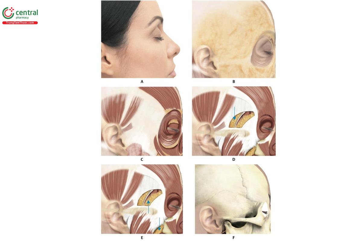Hình 6.6 Giải phẫu vùng thái dương. A. Hình bên của khuôn mặt. B. Mô dưới da sau khi loại bỏ da. C. Cân thái dương nông sau khi loại bỏ mô dưới da. D. Lớp mỡ thái dương, bên dưới cân thái dương nông và phía trên cân thái dương sâu. E. Khối mỡ má (khối mỡ Bichat) bên dưới cân thái dương sâu và phía trên cơ thái dương. F. Xương thái dương.