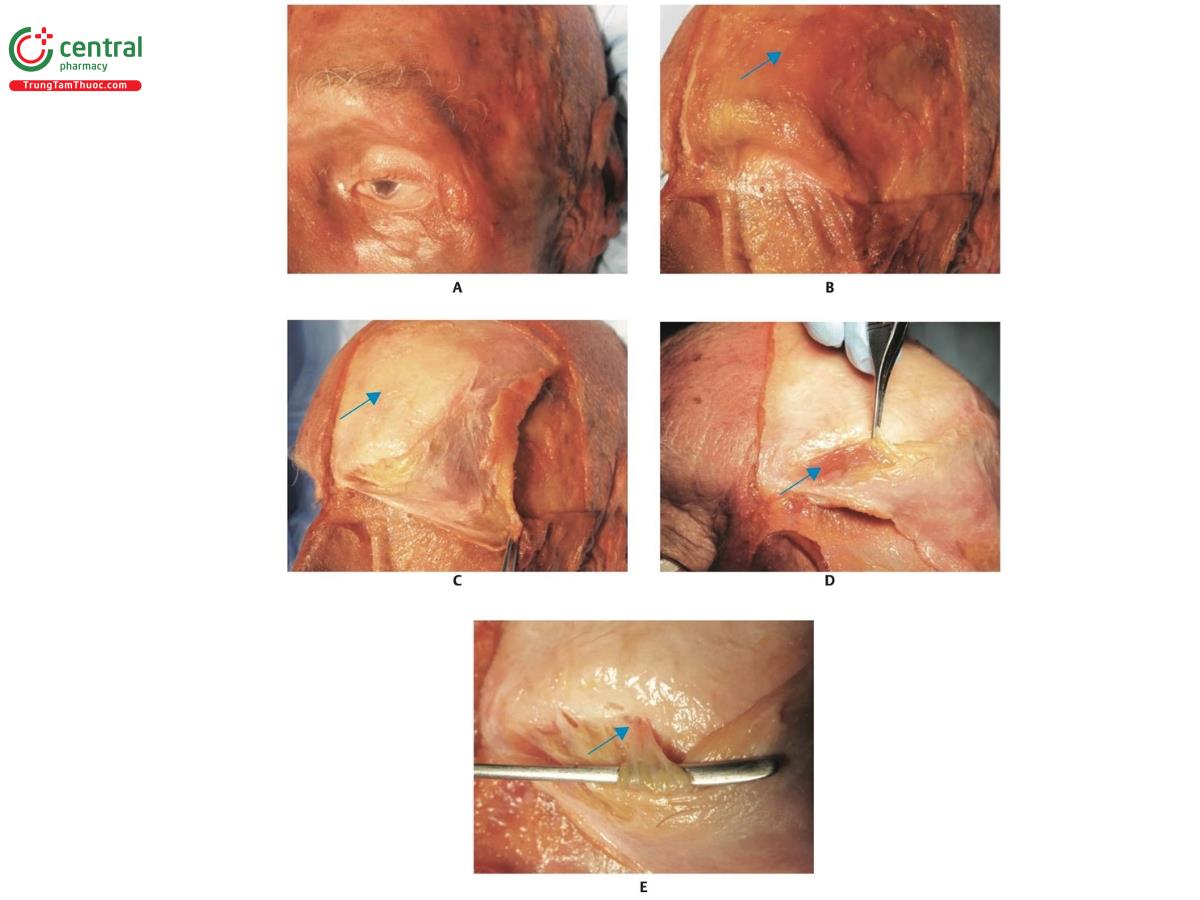 Hình 8.10 A. Bên trái khuôn mặt của xác tươi với da còn nguyên vẹn. B. Da được gập lại để lộ cơ trán (mũi tên màu xanh). C. Cơ trán được gập lại để lộ màng xương và xương trán (mũi tên màu xanh). D. Chú ý cơ cau mày (mũi tên màu xanh) nằm dưới cơ trán và được gập lại. E. Lỗ ra trên ổ mắt, thần kinh trên ổ mắt, tĩnh mạch và động mạch có thể nhìn thấy bên dưới cơ cau mày (mũi tên màu xanh). Không nên tiêm chất làm đầy gần lỗ ra trên ổ mắt hoặc lỗ trên ròng rọc. Chúng tôi đề xuất tiêm chất làm đầy trên vùng này 2,5 cm.