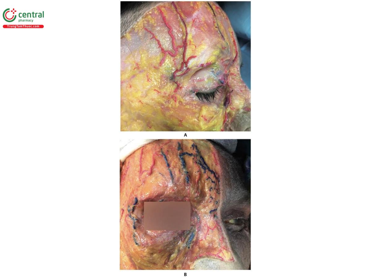 Hình 8.11 A. Bên phải khuôn mặt của xác tươi cho thấy các nhánh động mạch thái dương nông (STA) phía trên cơ trán. B. Bên phải khuôn mặt cho thấy nhánh trán của STA, tĩnh mạch trên ổ mắt và tĩnh mạch trên ròng rọc và, ở phía trong hơn, động mạch trên ròng rọc (STrA). Tất cả các mạch máu được mô tả đều nằm trên cơ trán, dính trong mô dưới da.