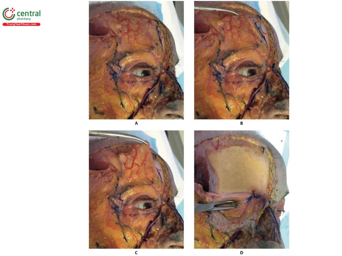Hình 8.13 A. Bên phải khuôn mặt của xác tươi với da và một phần mô dưới da của trán gập lại. B. Chú ý nhánh trán của động mạch thái dương nông (STA) màu đỏ, nằm trên cơ trán, được kéo lên. C. Cơ trán được gập lại cùng với các mạch máu nằm trên cơ. D. Xương trán lộ ra sau khi cơ trán được gập lại. Lỗ ra trên ổ mắt có thể nhìn thấy cách đường giữa khuôn mặt khoảng 27 mm, từ đó dây thần kinh, tĩnh mạch và động mạch trên ổ mắt đi ra.