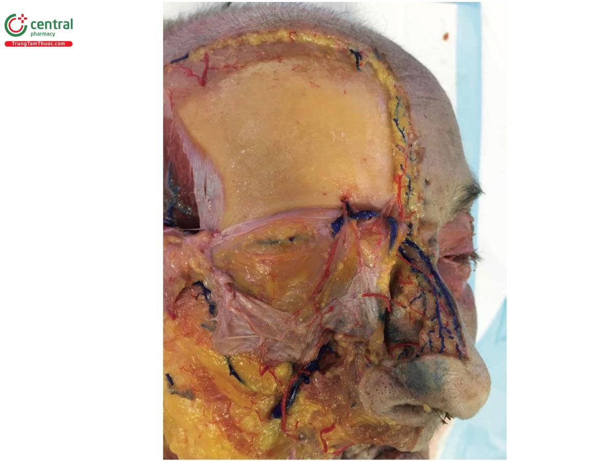 Hình 8.18 Bên phải khuôn mặt của xác tươi, có thể nhìn thấy dây thần kinh, tĩnh mạch và động mạch trên ổ mắt đi ra từ lỗ trên ổ mắt, sau khi loại bỏ da, mô dưới da và cơ trán. Chú ý không có mạch máu ở trên xương trán và phía trong từ tĩnh mạch và động mạch trên ròng rọc, trong mô dưới da.