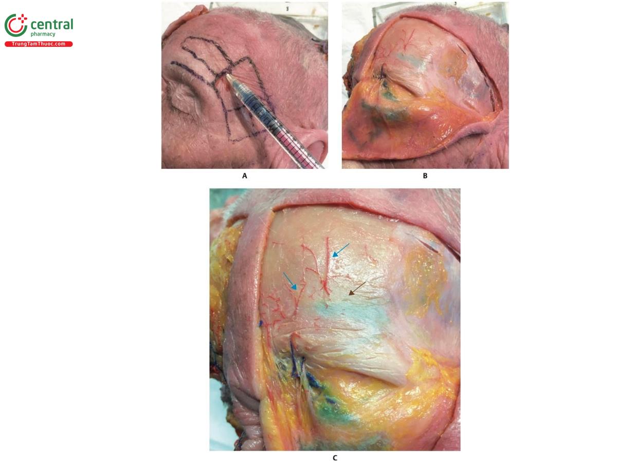 Hình 8.21 A. Tiêm HA màu xanh, với cannula ở mặt phẳng trên màng xương, ở phía bên trái trán của một xác tươi. B. Da, mô dưới da và cơ trán được gấp lại. C. Chú ý các mạch máu lớn hơn được gấp lại, vì chúng nằm giữa mô dưới da và cơ trán. Thấy các động mạch nhỏ (mũi tên màu xanh) trên màng xương, chức năng duy nhất của chúng là nuôi dưỡng màng xương. Do đó, mặt phẳng trên màng xương được coi là vị trí an toàn nhất để tiêm chất làm đầy ở trán. Chú ý vùng màu xanh nhạt (mũi tên màu nâu); đây là vị trí mà HA được tiêm trong hình A.