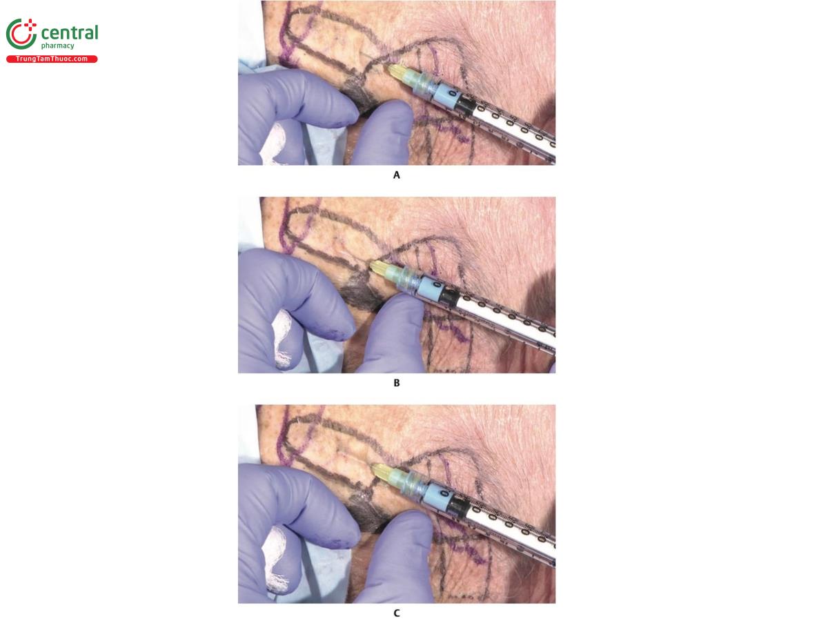 Hình 8.25 A. 1/3 trên bên trái khuôn mặt của xác tươi. Lưu ý các đánh dấu (màu đen) ở vùng trán cần tiêm và kim 27 G x 13 mm được đưa vào mặt phẳng trong da của vùng này. B. Kim 27 G x 13 mm được đưa vào mặt phẳng trong da; chú ý đường viền nổi mà kim gây ra. C. Kim 27 G x 13 mm được đưa vào mặt phẳng trong da. Đường viền nổi cho thấy mặt phẳng tiêm khá nông. Kỹ thuật này được chỉ định để điều chỉnh các nếp nhăn ngang trên trán như một phương pháp bổ sung cho botulinum toxin.