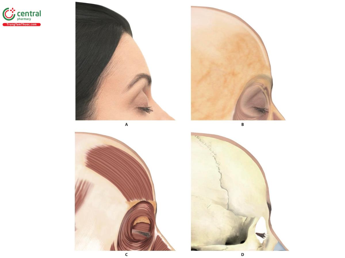 Hình 8.4 A. Hình nghiêng bên phải của người mẫu 3D cho thấy chi tiết của trán. B. Sau khi loại bỏ da, bộc lộ lớp mỡ nông (SFP). C. Sau khi loại bỏ da và SFP, bộc lộ cơ trán và cơ vòng mắt (OM). Lớp mỡ ROOF có thể thấy ở sau vùng này. D. Cấu trúc xương của vùng trán. 