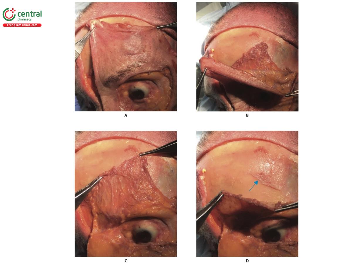 Hình 8.7 A. 1/3 trên bên trái khuôn mặt của xác tươi với da được kéo lên. B. Da được gập lại, bộc lộ cơ trán và màng xương. C. Cơ trán được kéo lên. D. Cơ trán được gập lại, bộc lộ màng xương (mũi tên màu xanh) và xương trán.