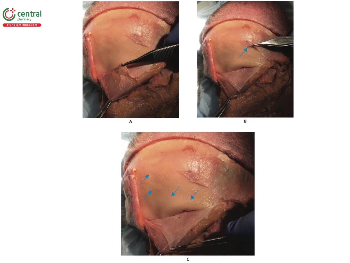 Hình 8.8 A. Bên trái khuôn mặt của xác tươi với cơ trán được kéo lên và gập lại. B. Màng xương được kéo lên (mũi tên màu xanh). C. Bộc lộ xương trán. Lưu ý các chỗ lõm xương (mũi tên màu xanh) nơi các lớp mỡ nông (SFP) của trán mật độ dày hơn.
