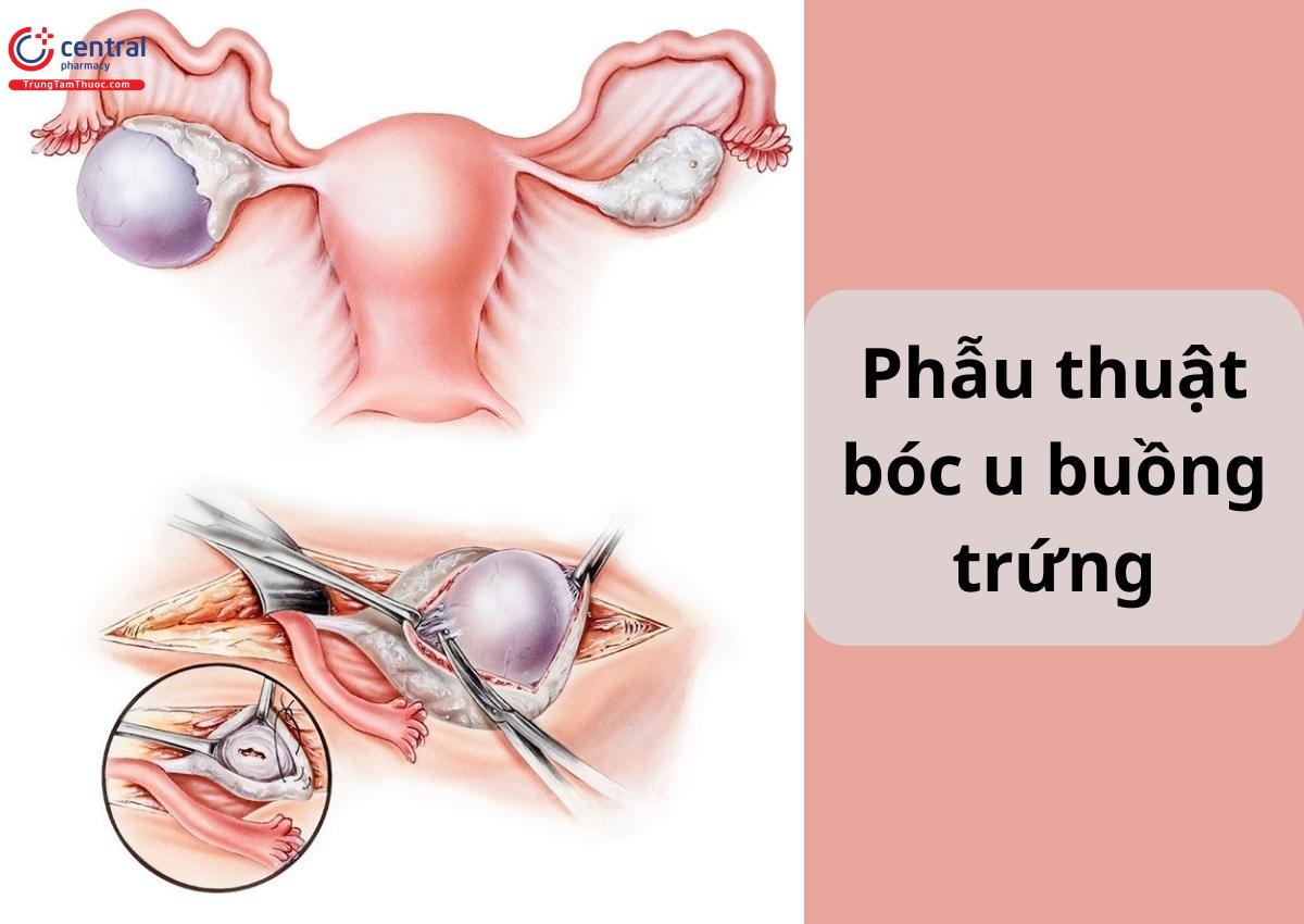 Phẫu thuật bóc u buồng trứng