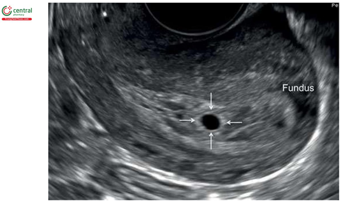 Hình 4.1: Mặt cắt dọc giữa tử cung với túi thai lúc 4,5 tuần tuổi. Lưu ý, các đường viền (mũi tên) hồi âm dày của túi thai. Các đường viền hồi âm dày (vòng) của túi thai giúp phân biệt nó với dịch hoặc ổ máu tụ trong tử cung. Phần đáy của tử cung được ghi chú để định hướng.