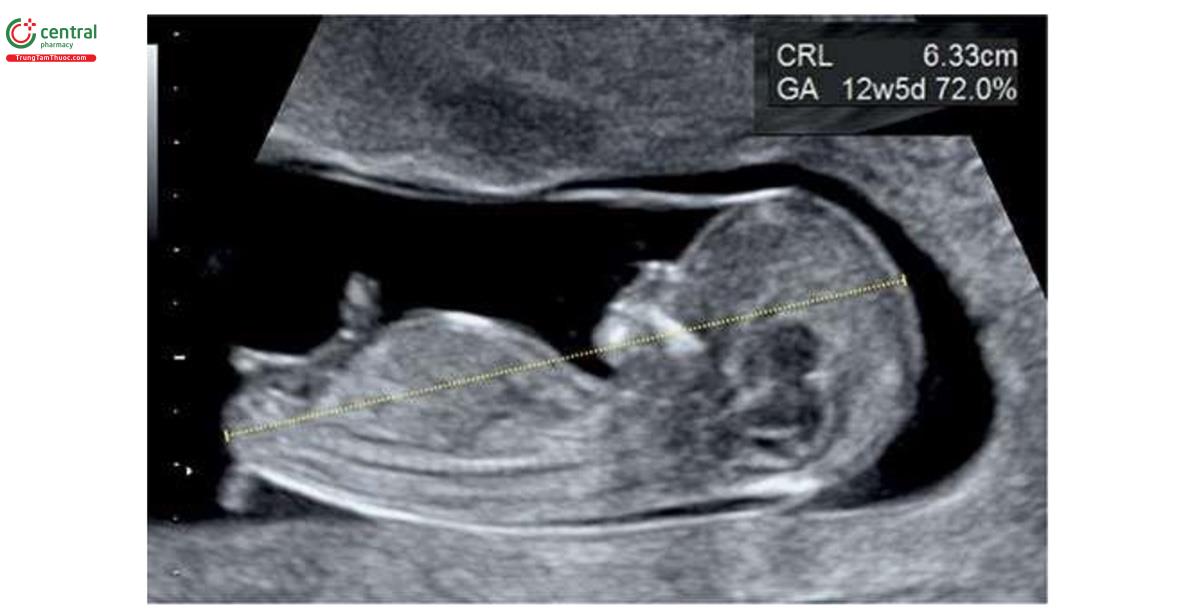 Hình 4.13: Đo chiều dài đầu-mông (CRL) của thai nhi 12+5 tuần tuổi. Lưu ý, phép đo CRL tương ứng với đường thẳng dài nhất từ đỉnh đầu đến vùng mông. GA, tuổi thai.