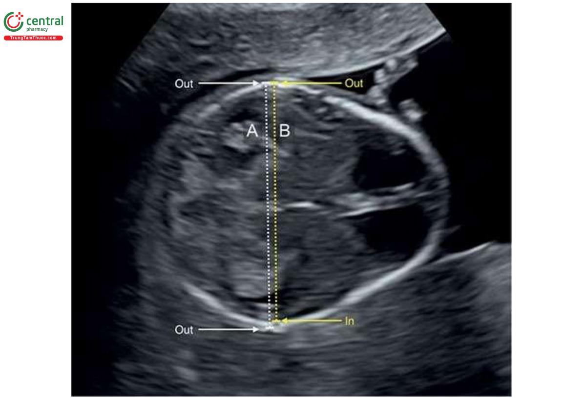Hình 4.14: Đo đường kính lưỡng đỉnh (BPD) của thai nhi 13 tuần tuổi. Tùy theo cài đặt, phép đo được thực hiện từ bờ ngoài tới bờ ngoài (A) hoặc từ bờ ngoài tới bờ trong (B). Xem Bảng 4.2 để biết thêm chi tiết.