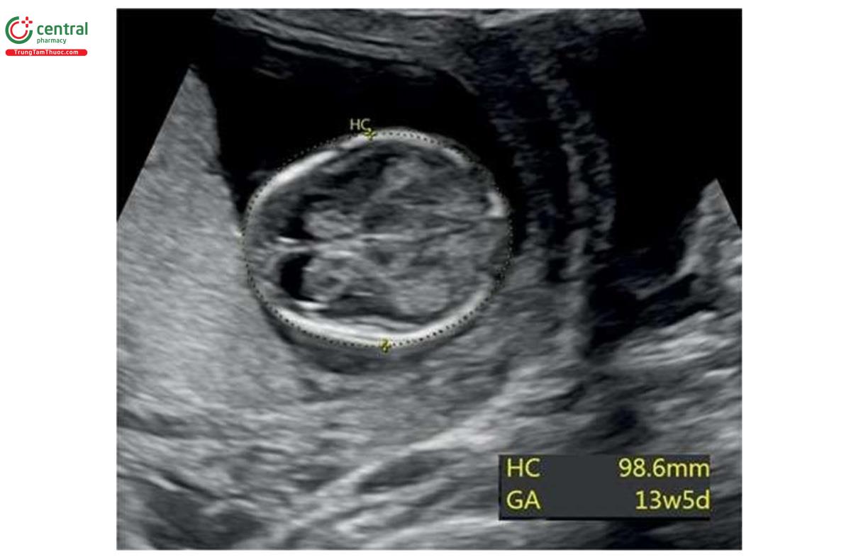 Hình 4.15: Đo chu vi đầu (HC) của thai nhi 13+5 tuần tuổi. Lưu ý, các thước cặp được đặt từ bên ngoài tới bên ngoài để đo HC. GA, tuổi thai.