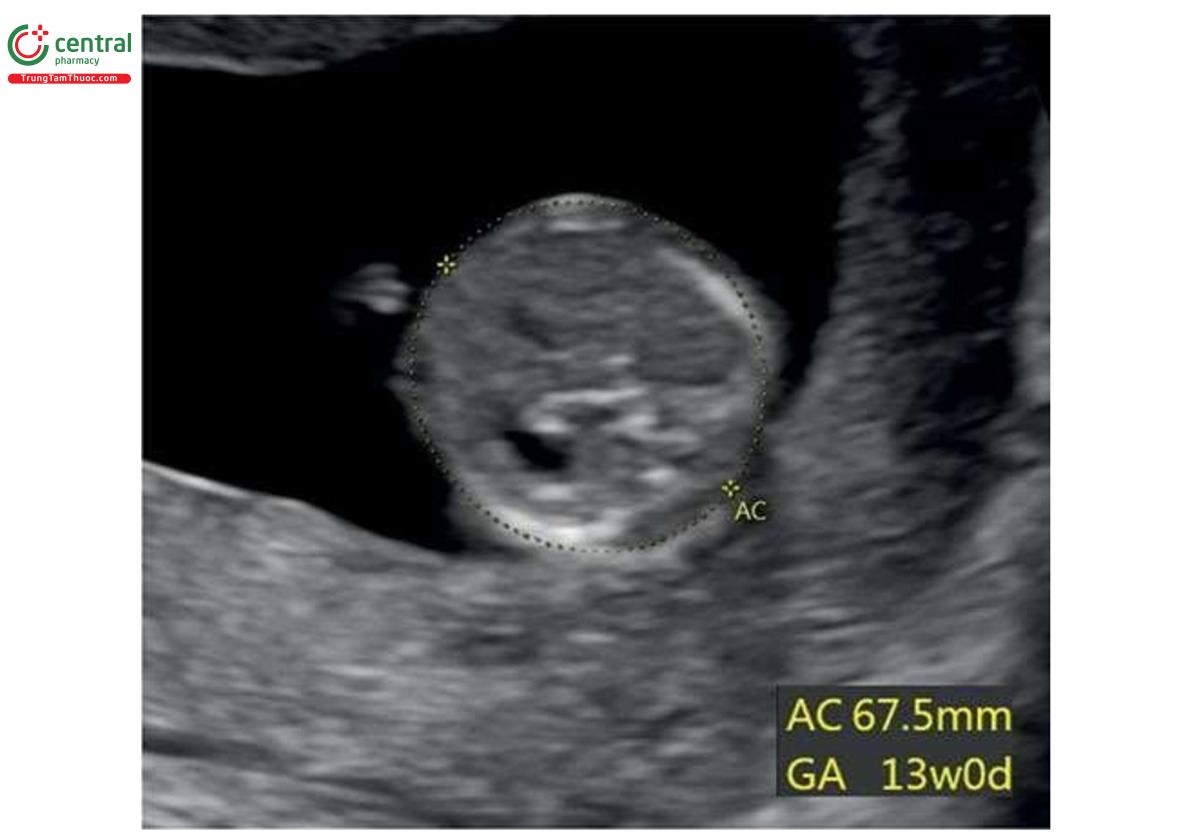 Hình 4.16: Đo chu vi bụng (AC) của thai nhi 13 tuần tuổi. Xem Bảng 4.3 để biết thêm chi tiết. GA, tuổi thai.