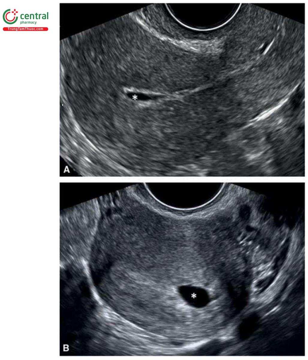 Hình 4.2: Mặt cắt dọc giữa (A) và mặt cắt ngang (B) của hai tử cung cho thấy sự tích tụ dịch (dấu hoa thị) giữa các lớp màng rụng. Dấu hiệu này không nên nhầm lẫn với túi thai trong tử cung. Xem văn bản để biết thêm chi tiết.