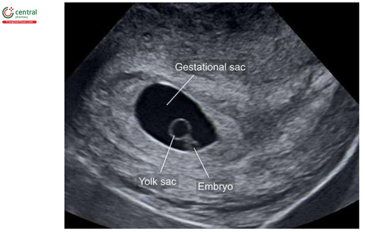 Hình 4.3: Mặt cắt dọc giữa tử cung với túi thai lúc 6 tuần tuổi. Lưu ý, thấy 1 túi noãn hoàng và 1 phôi thai nhỏ. Hình dạng của túi thai có hình elip hơn là hình tròn.