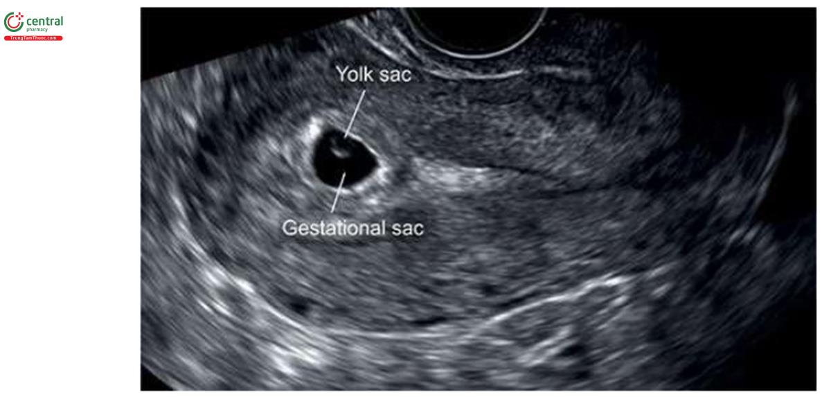 Hình 4.4: Mặt cắt dọc giữa tử cung với túi thai lúc 5,5 tuần tuổi. Lưu ý, thấy túi noãn hoàng trong túi thai với đường viền hồi âm dày.