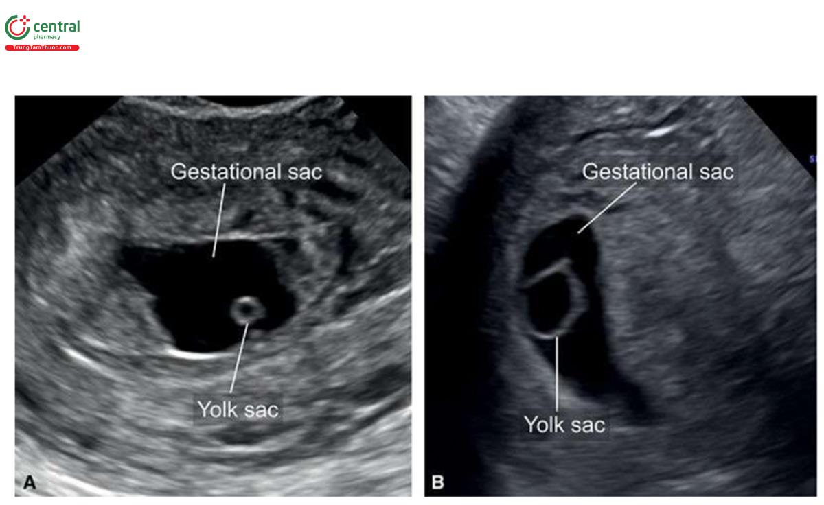 Hình 4.5: A và B: Hai túi thai với kích thước túi noãn hoàng bất thường: nhỏ ở A và lớn ở B. Kích thước túi noãn hoàng bất thường là dấu hiệu đáng ngại của một thai kỳ bất thường và cần phải siêu âm theo dõi.