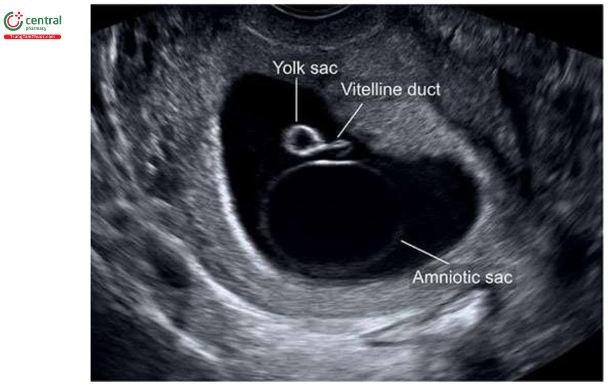 Hình 4.6: Túi thai lúc 7 tuần tuổi. Túi ối được thấy như một màng mỏng hình tròn phản chiếu. Túi noãn hoàng và ống noãn hoàng được thấy như những cấu trúc ngoài túi ối.