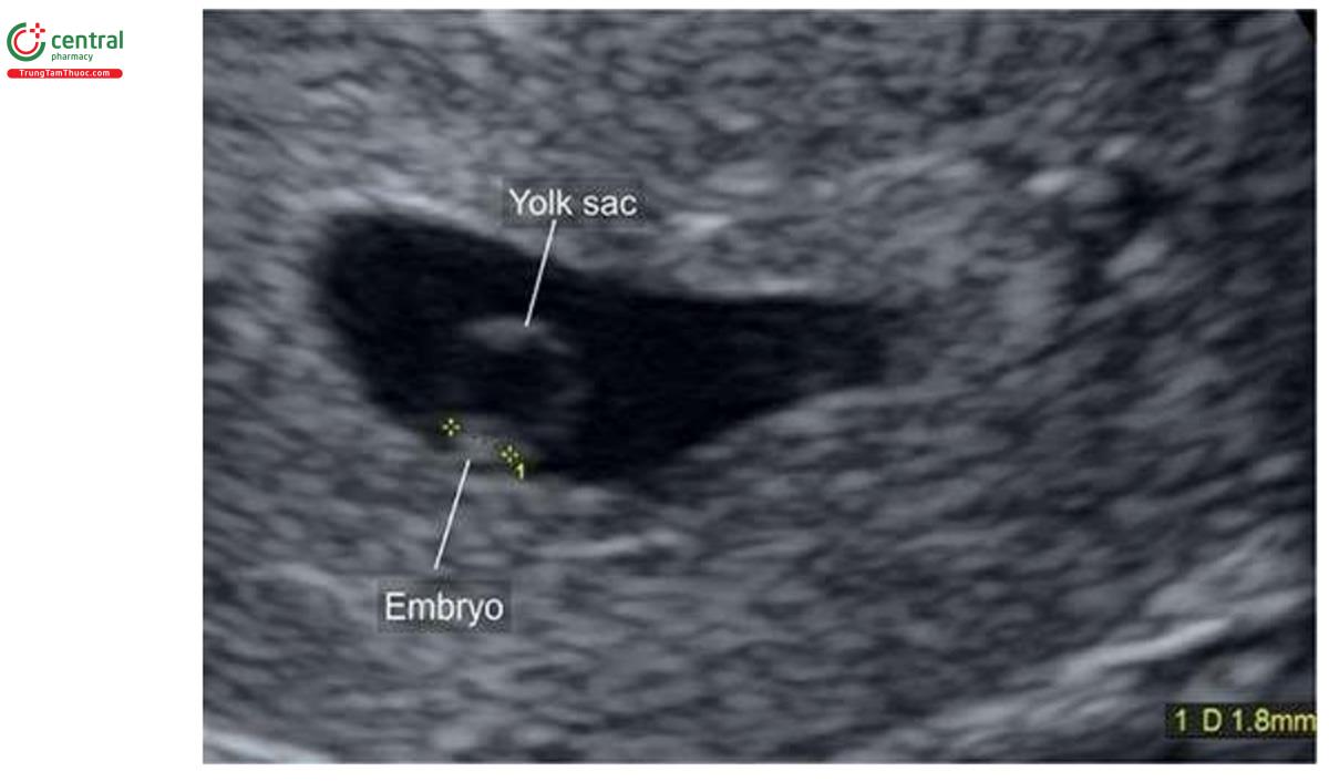 Hình 4.7: Siêu âm qua ngả âm đạo thấy túi thai với 1 phôi thai có kích thước 1,8 mm. Lưu ý, vị trí túi noãn hoàng gần với phôi.