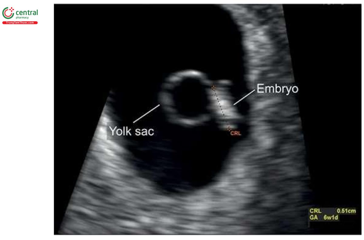 Hình 4.8: Túi thai lúc 6 tuần tuổi với phôi thai có chiều dài đầu-mông (CRL) là 5,1 mm. Lưu ý, phôi có hình dạng thẳng, giống như —hạt gạo”. Nhìn thấy túi noãn hoàng cạnh phôi thai. GA, tuổi thai.