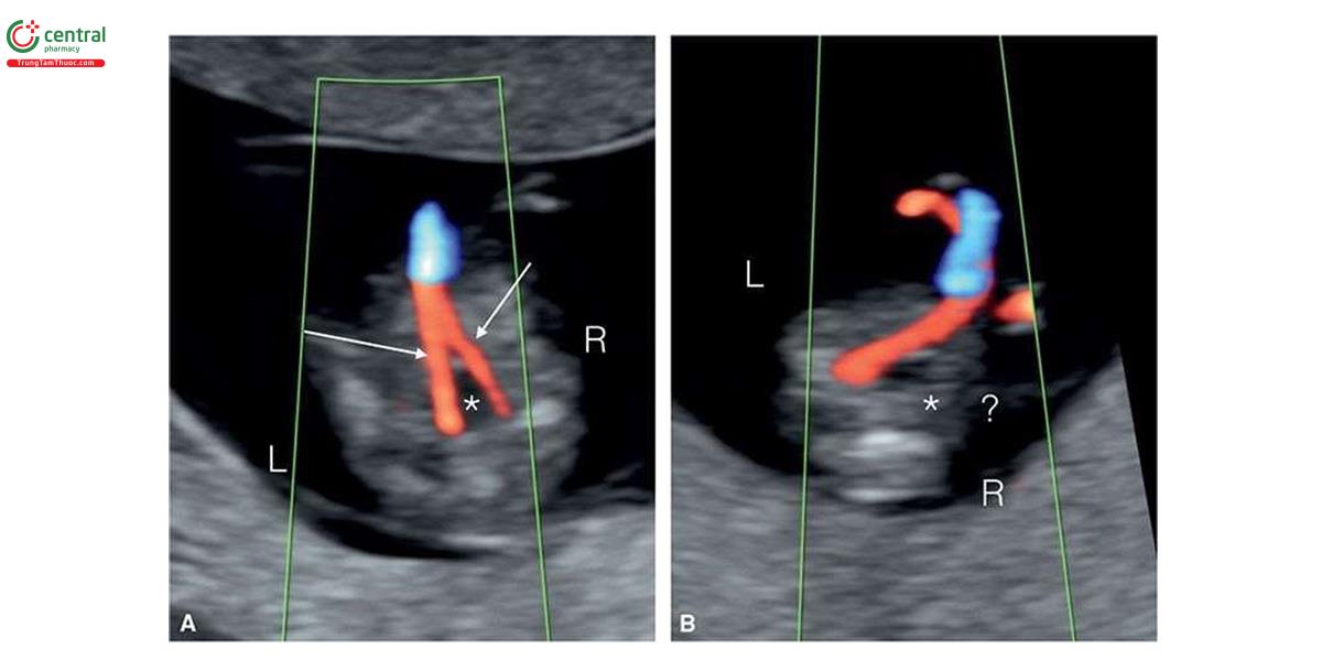 Hình 3.10: Mặt cắt ngang tiểu khung với Doppler màu ở 2 thai nhi (A và B) 12 tuần tuổi, sử dụng đầu dò cong. Lưu ý ở A, thấy 2 động mạch rốn (mũi tên) bao quanh bàng quang (dấu hoa thị). Không thấy động mạch rốn bên phải (?) bàng quang (dấu hoa thị) ở thai nhi B. L, trái; R, phải.