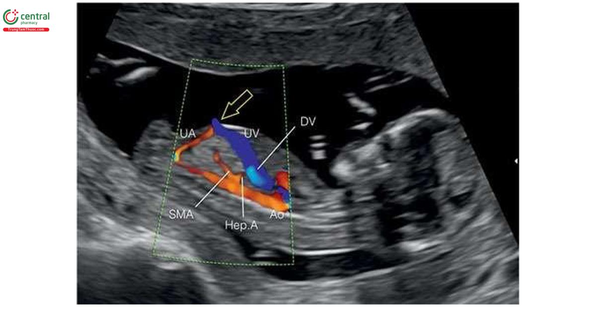 Hình 3.11: Mặt cắt dọc của ngực và bụng với Doppler màu ở thai nhi 11 tuần tuổi cho thấy thành bụng trước nguyên vẹn (mũi tên rỗng) và vị trí cắm của động mạch rốn (UA) và tĩnh mạch rốn (UV) vào thành bụng. Mặt cắt này cũng cho thấy UV có đường đi bình thường trong ổ bụng và ống tĩnh mạch hẹp (DV), đổ vào tim, và đây cũng là mặt cắt lý tưởng để thực hiện Doppler xung DV ở tuổi thai nhỏ (xem Hình 3.17). Ở phía sau động mạch chủ xuống (Ao), thấy động mạch gan (Hep.A) và động mạch mạc treo tràng trên (SMA) xuất phát từ động mạch chủ theo hướng vuông góc (xem Hình 3.7). Không thấy tĩnh mạch chủ dưới ở mặt cắt này vì nó chạy ở bụng bên phải.