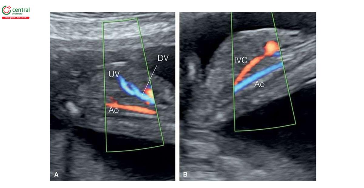 Hình 3.12: Mặt cắt dọc bụng (A và B) với Doppler màu của cùng một thai nhi lúc 13 tuần tuổi. Lưu ý ở A, thấy ống tĩnh mạch (DV) ở bụng giữa cùng với động mạch chủ xuống (Ao), ở phía sau. Không thấy tĩnh mạch chủ dưới (IVC) vì nó chạy ở bụng bên phải. Ở B, khi định hướng lại đầu dò, thấy IVC kết nối với tim cùng với Ao xuống nhưng không thấy DV. Lưu ý, màu xanh lam trong động mạch chủ ở B (dòng chảy đi ra xa đầu dò) do định hướng lại đầu dò.