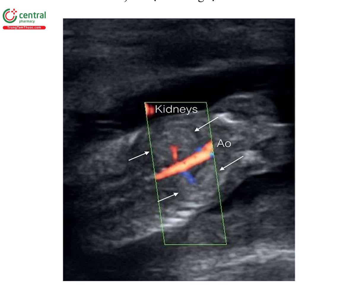 Hình 3.13: Mặt cắt vành của bụng sau và tiểu khung với Doppler màu của thai nhi 13 tuần tuổi cho thấy động mạch chủ xuống (Ao) với động mạch thận trái và phải xuất phát từ Ao và chạy về phía thận (mũi tên).