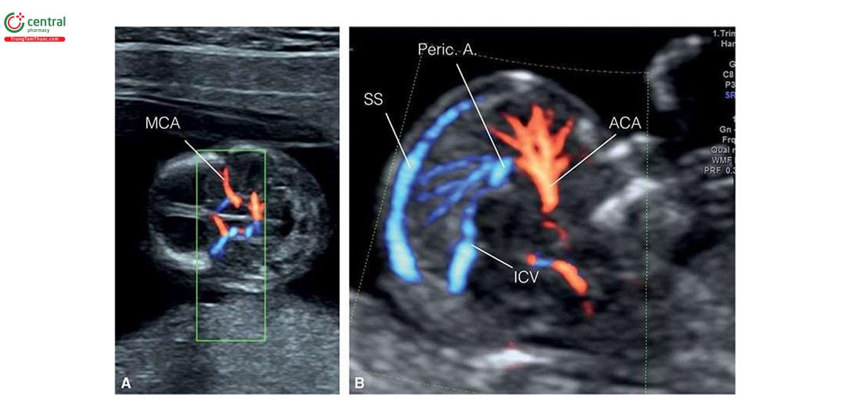 Hình 3.15: A: Mặt cắt ngang nền hộp sọ thai nhi 13 tuần tuổi với Doppler màu cho thấy đa giác Willis với động mạch não giữa (MCA). B: Mặt cắt dọc giữa đầu thai nhi với Doppler màu ở thai nhi 12 tuần tuổi cho thấy động mạch não trước (ACA), phần gần của động mạch quanh thể chai (Peric.A.) và tĩnh mạch não trong (ICV) đi về phía sau dọc bờ của đồi thị. Cũng thấy dòng máu chảy trong xoang dọc (SS) ở phía trước.