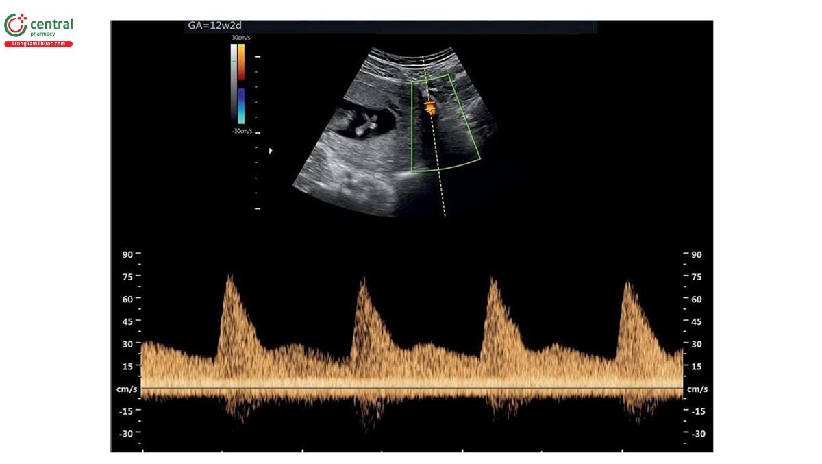 Hình 3.16: Doppler màu và xung động mạch tử cung ở thai nhi 12 tuần tuổi (GA). Phổ Doppler xung động mạch tử cung đã được ứng dụng để đánh giá nguy cơ thai kỳ ở một số cơ sở y tế. Xem văn bản để biết thêm chi tiết.