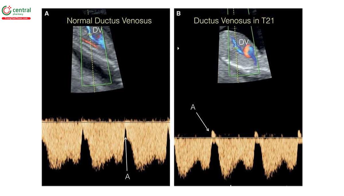 Hình 3.17: Doppler màu và xung ống tĩnh mạch (DV) ở 2 thai nhi A và B. Lưu ý, cửa sổ Doppler nhỏ và được đặt trong DV, với góc Doppler < 20o đến 30o. Phổ Doppler DV bình thường có dạng 2 pha đặc trưng với dòng chảy xuôi dòng (antegrade flow) trong giai đoạn tâm nhĩ co bóp (A) như ở thai nhi A. Lưu ý, dòng chảy ngược bất thường trong giai đoạn tâm nhĩ co bóp (A) ở thai nhi B.
