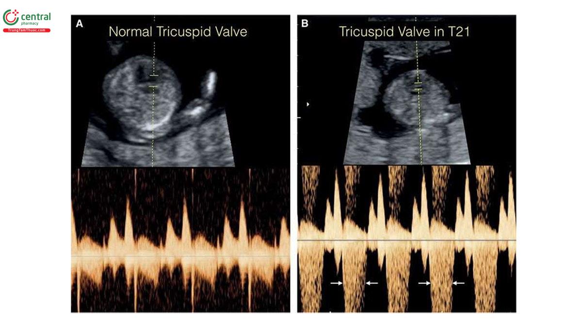 Hình 3.18: Các phổ Doppler xung qua van ba lá lúc 12 tuần tuổi ở thai nhi bình thường (A) và ở thai nhi (B) bị trisomy 21 (T21) có hở van ba lá nặng (mũi tên).