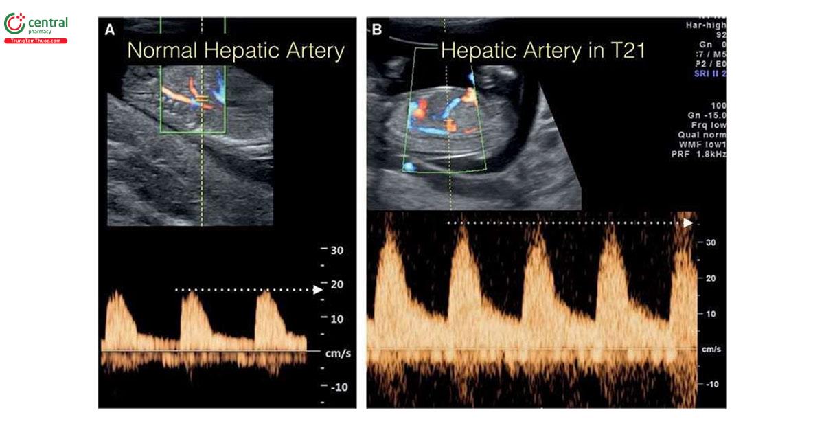 Hình 3.19: Phổ Doppler động mạch gan lúc 12 tuần tuổi ở thai nhi bình thường (A) và ở thai nhi (B) có trisomy 21 (T21). Lưu ý, vận tốc đỉnh tâm thu thấp (18 cm/giây) ở thai nhi A bình thường, so với vận tốc cao (35 cm/giây) ở thai nhi có trisomy 21 (T21) (B).