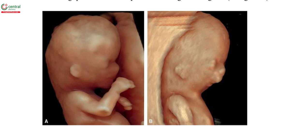 Hình 3.27: Siêu âm 3D ở chế độ bề mặt lúc 12 tuần tuổi ở thai nhi bình thường (A) và thai nhi có khuôn mặt dị thường với tai bất thường và cằm nhỏ (micrognathia) (B).