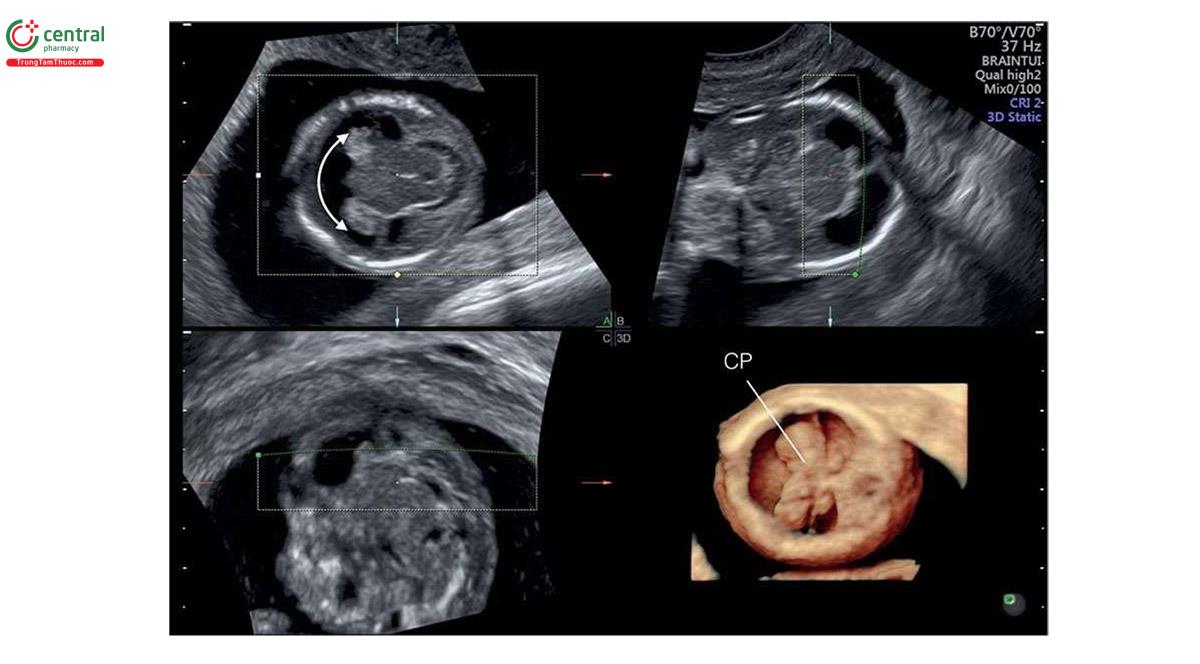 Hình 3.29: Siêu âm 3D đầu thai nhi 12 tuần tuổi có não thất duy nhất (holoprosencephaly), qua ngả âm đạo, được hiển thị ở chế độ trực giao (A, B, C) và bề mặt (3D). Ở hình dưới bên phải, dựng hình 3D cho thấy đám rối màng mạch hợp nhất (CP), não thất duy nhất (mũi tên hai đầu ở A) và không có liềm não. So sánh với giải phẫu não bình thường ở Hình 3.28.